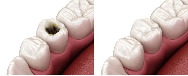 Dental Implants